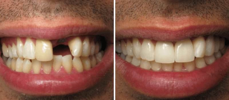 Dental-Implant-1