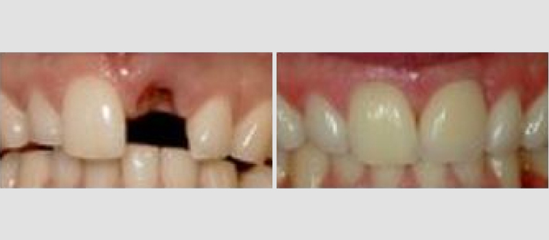 Dental-Implant-2-1