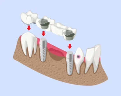 restorative dentistry in Houston, TX